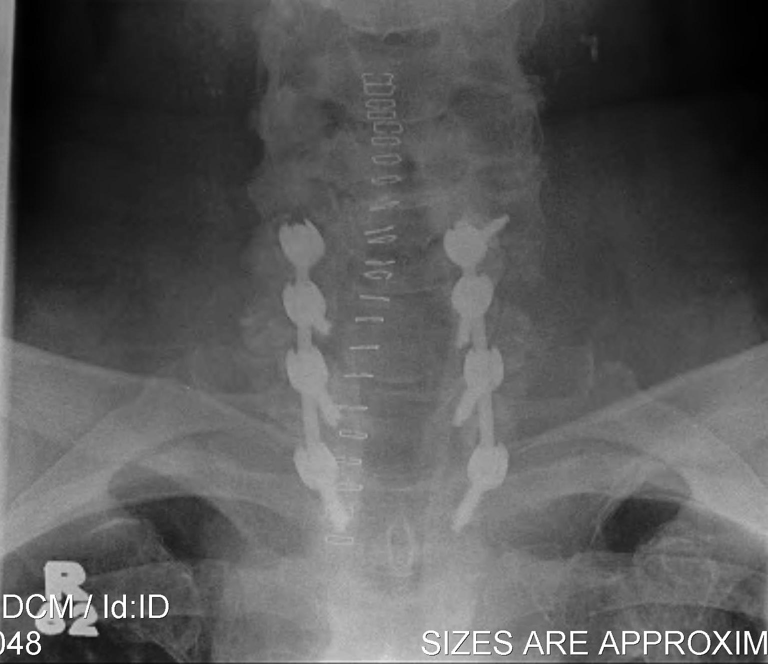 Cervical Spine Posterior Fusion for SAS